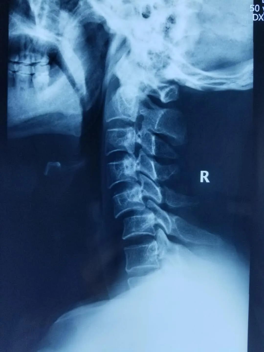 颈椎脱位莫大意，专业医治防瘫痪——省中医院李红专主任团队成功治疗一例复杂陈旧性颈椎骨折脱位患者