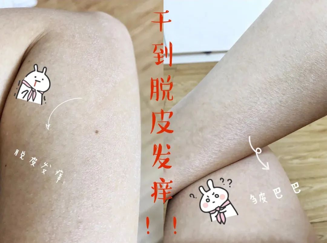 啤酒消痘痘,喝啤酒会消除痘痘吗