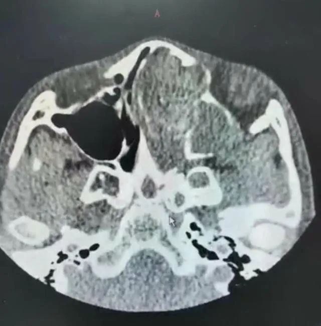 儿研所看鼻炎,儿研所鼻炎清治过敏鼻炎吗