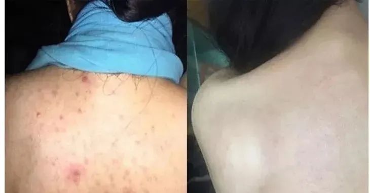 法国Lérane草本净螨贴，萃取天然植物，除螨更安心