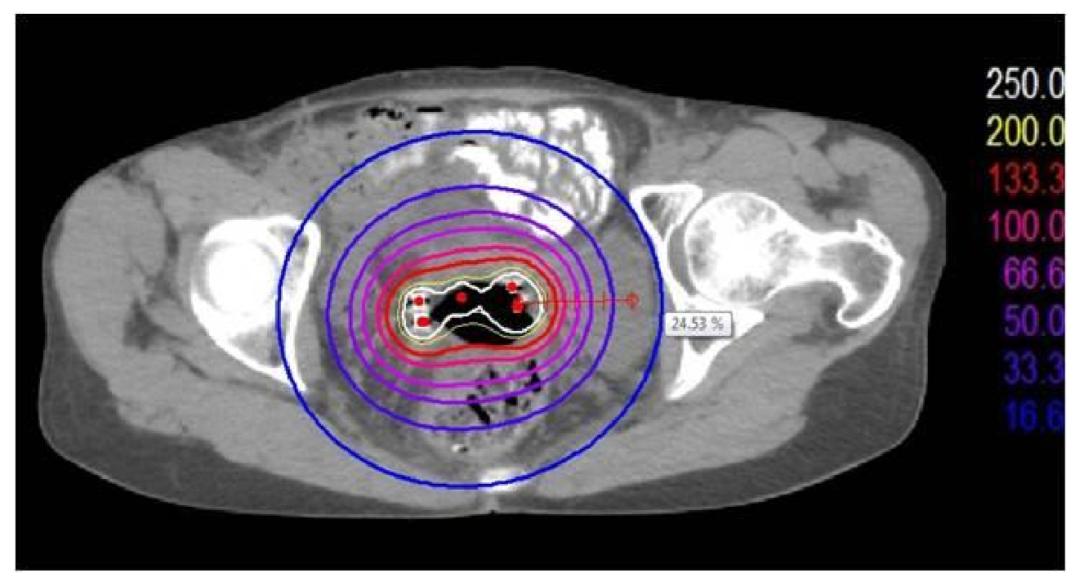 曹新平教授组稿|欧阳翼：宫颈癌的放射治疗