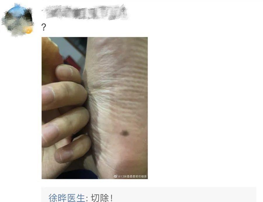 容易癌变的痣去哪里切除,从小就有的痣要切除吗