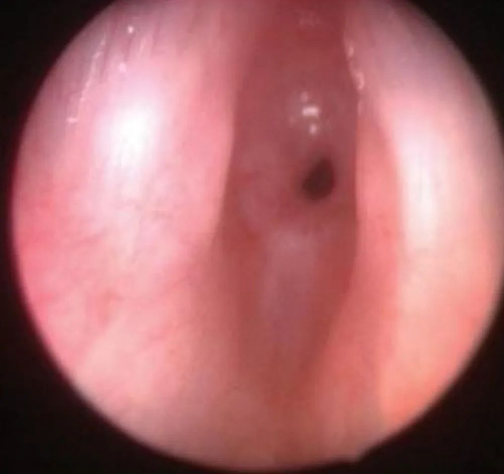 气道异物患者麻醉,小儿气道异物麻醉