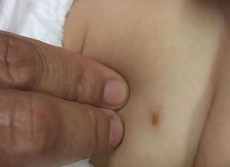 7岁女童持续6天高烧,七个月婴儿反复高烧怎么回事