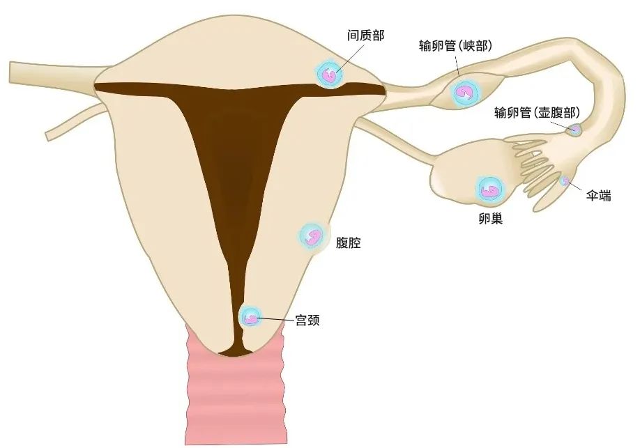 【妇产科普】“要命”的宫外孕，这4类女性一定要当心！