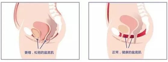 近在咫尺，却相忘于天涯——盆底肌