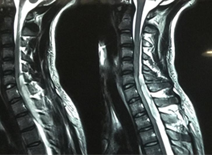 这个病例，教你避开缺血性脑卒中静脉溶栓的隐秘陷阱丨病例探究