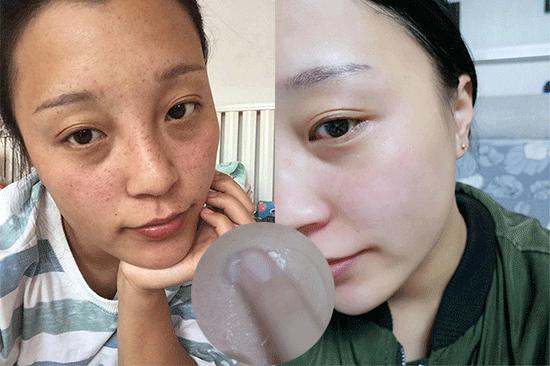 花了3万做激光,才彻底懂了:医生为什么劝你别去斑