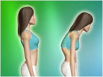 含胸驼背最损气质手把手教你纠正,含胸驼背如何改善提升气质