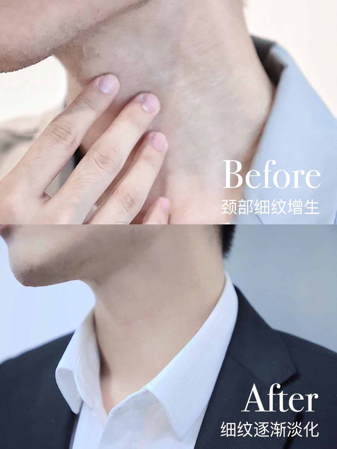 女人脖子有颈纹和年龄有关吗,一条颈纹代表二十岁