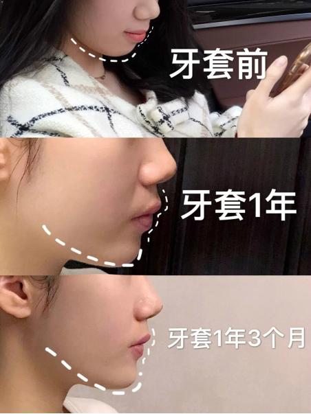 昆明龅牙矫正要多少钱,长沙轻微龅牙矫正要多少钱