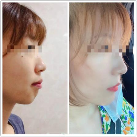 昆明龅牙矫正哪家便宜,长沙成人隐形牙齿矫正龅牙