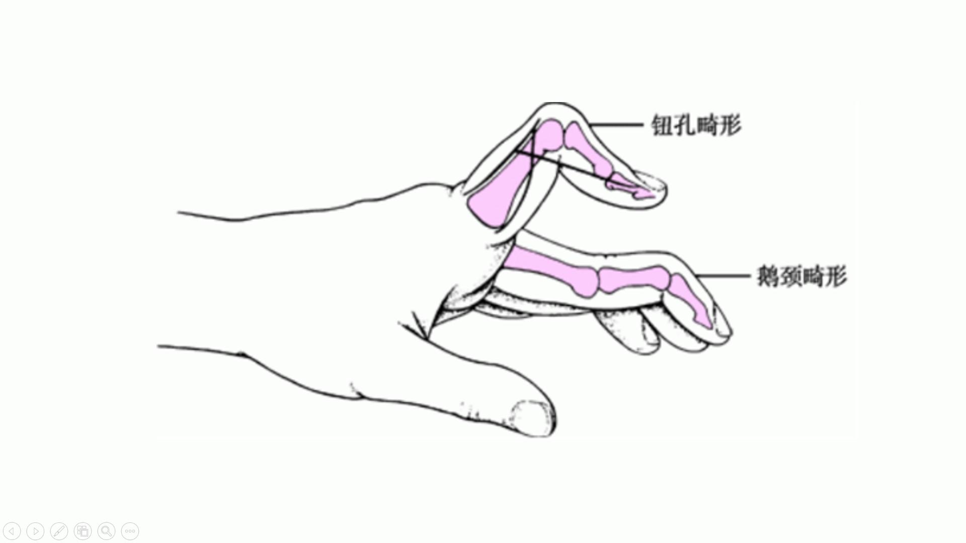 有类风湿症状没有类风湿因子,不是类风湿病吃类风湿药有啥症状