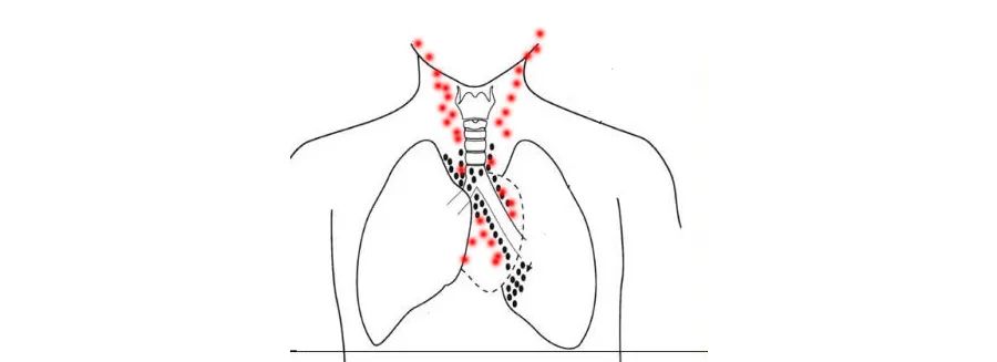 咽鼓管有积液能引起头胀头疼吗,咽鼓管堵塞导致鼓室积液