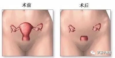 50女人切子宫有影响吗,一个女人把子宫切了是什么疾病