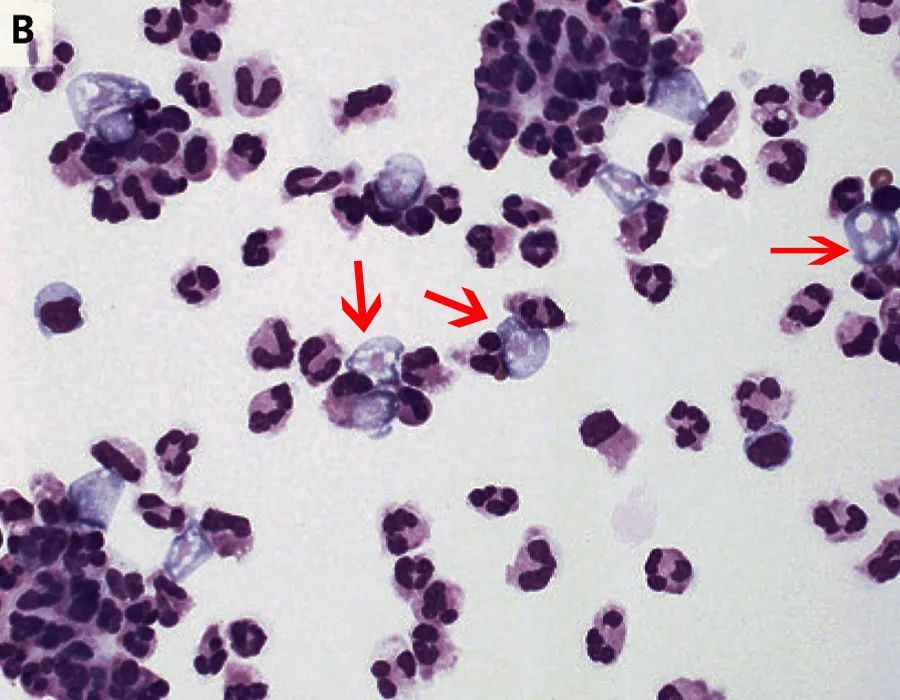 游泳得脑膜炎,游泳发烧会引起脑损伤吗