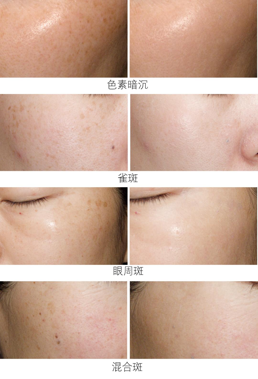 爱长斑的女人怎么办,女生长斑