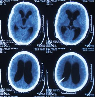 脑积水腹腔分流术后头晕头痛,脑积水分流术后发烧会有什么后果