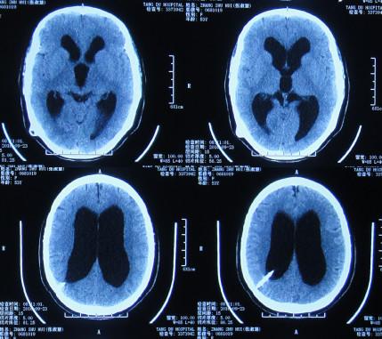 脑积水腹腔分流术后头晕头痛,脑积水分流术后发烧会有什么后果