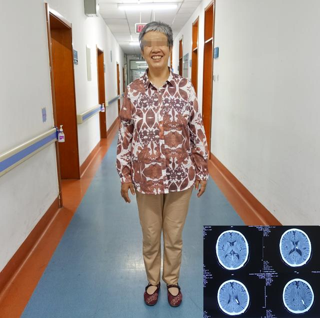 脑积水腹腔分流术后头晕头痛,脑积水分流术后发烧会有什么后果