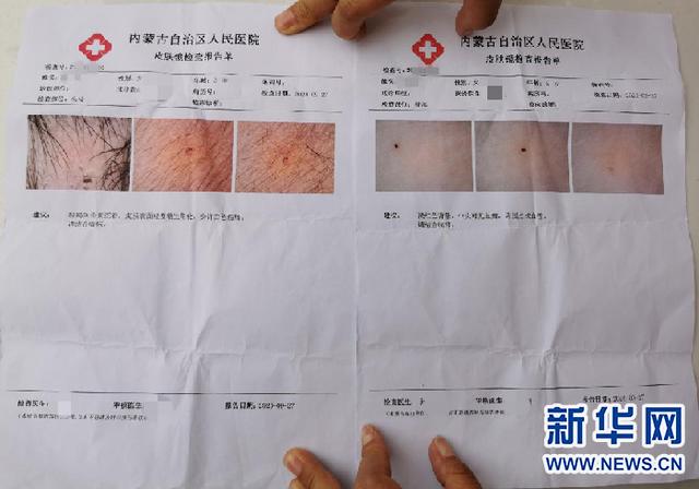 幼儿园针扎8名儿童,幼儿园儿童被针扎