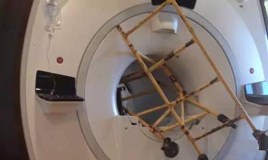 一个节育环引发血案,避孕环的事件