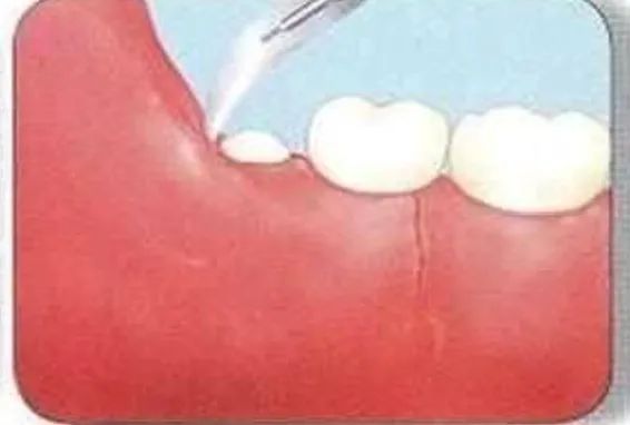 智齿组图,智齿大全