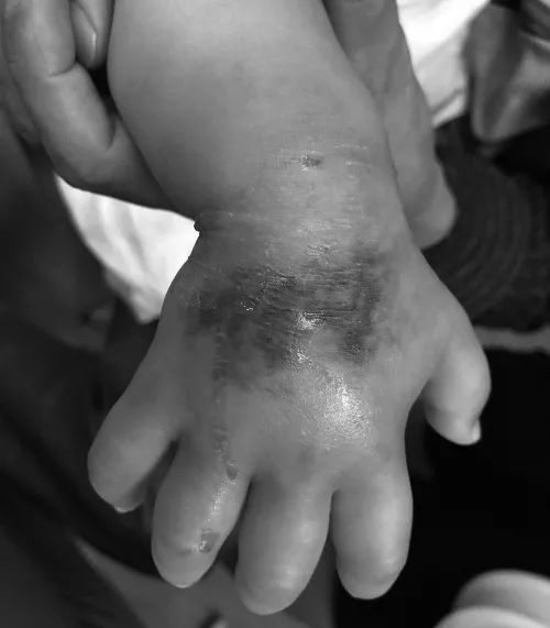 碰了一下手就麻的植物,碰了下肿了个大疙瘩