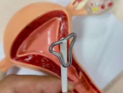 被遗忘在女人体内的「节育环」，该取出来了。