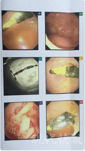 被遗忘在女人体内的「节育环」，该取出来了。