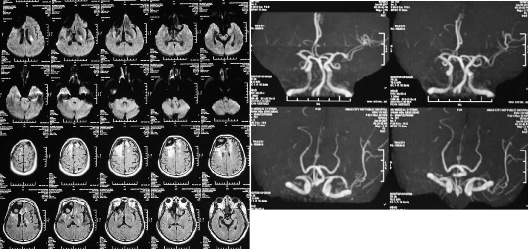 从基础到应用——MMSE、MoCA量表的使用，知多少？