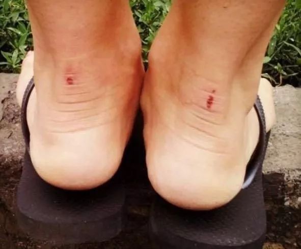 你穿高跟鞋经历过磨脚的痛苦吗,穿高跟鞋脚掌死皮怎么去除