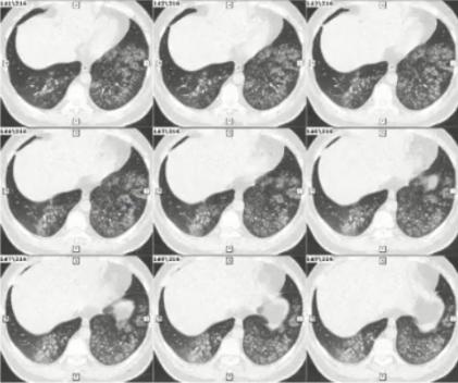 支原体肺炎症状中医诊治,成人肺炎支原体肺炎诊治专家共识
