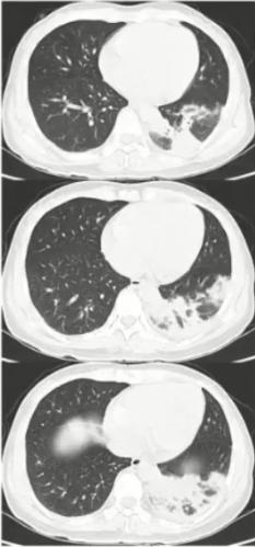 支原体肺炎症状中医诊治,成人肺炎支原体肺炎诊治专家共识