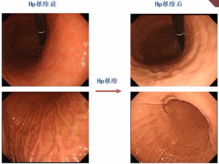 CGC2020|吕宾教授：Hp根除对胃黏膜的影响（附内镜下图像）
