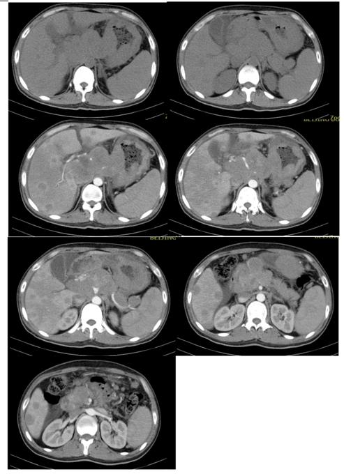 弥漫大b细胞淋巴瘤cd30阴性,cd30阳性淋巴瘤靶向药