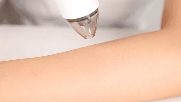 痘痘挤出的白米粒是什么,痘痘挤出来的白色乳浆是什么