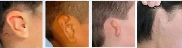 小耳畸形患者救助项目,小耳畸形援助最新消息