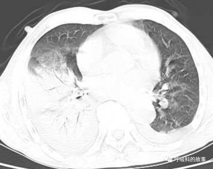 肺炎的最佳治疗方法及药物,肺炎的治疗方法和流程