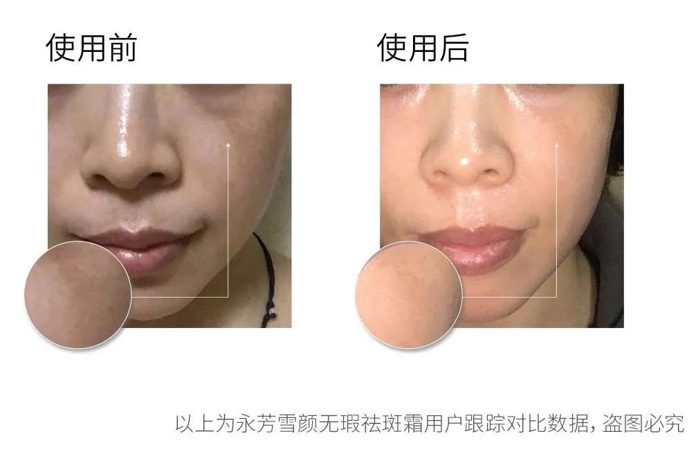 推荐一下你们用过的最好的祛斑霜,公认十大最好的祛斑霜