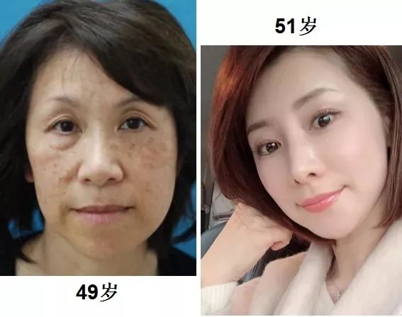 花了3万做激光，才彻底懂了：医生为什么劝你别去斑