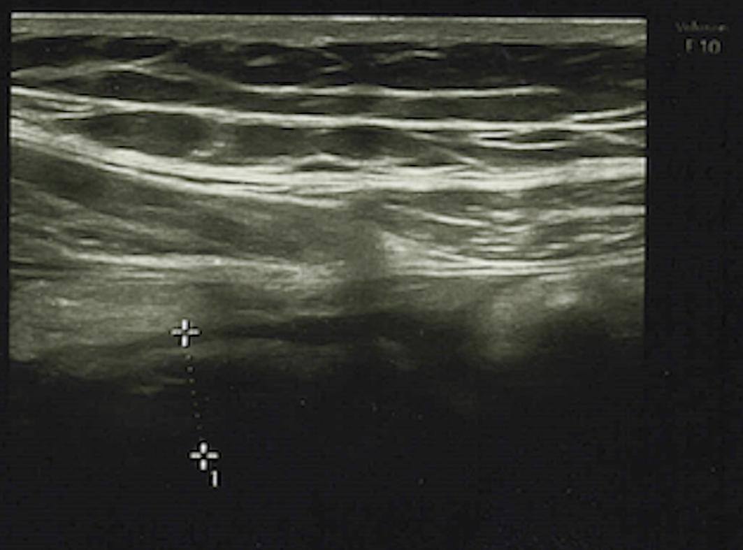 小儿急性腹痛常见原因,急性腹痛伴休克最常见的原因