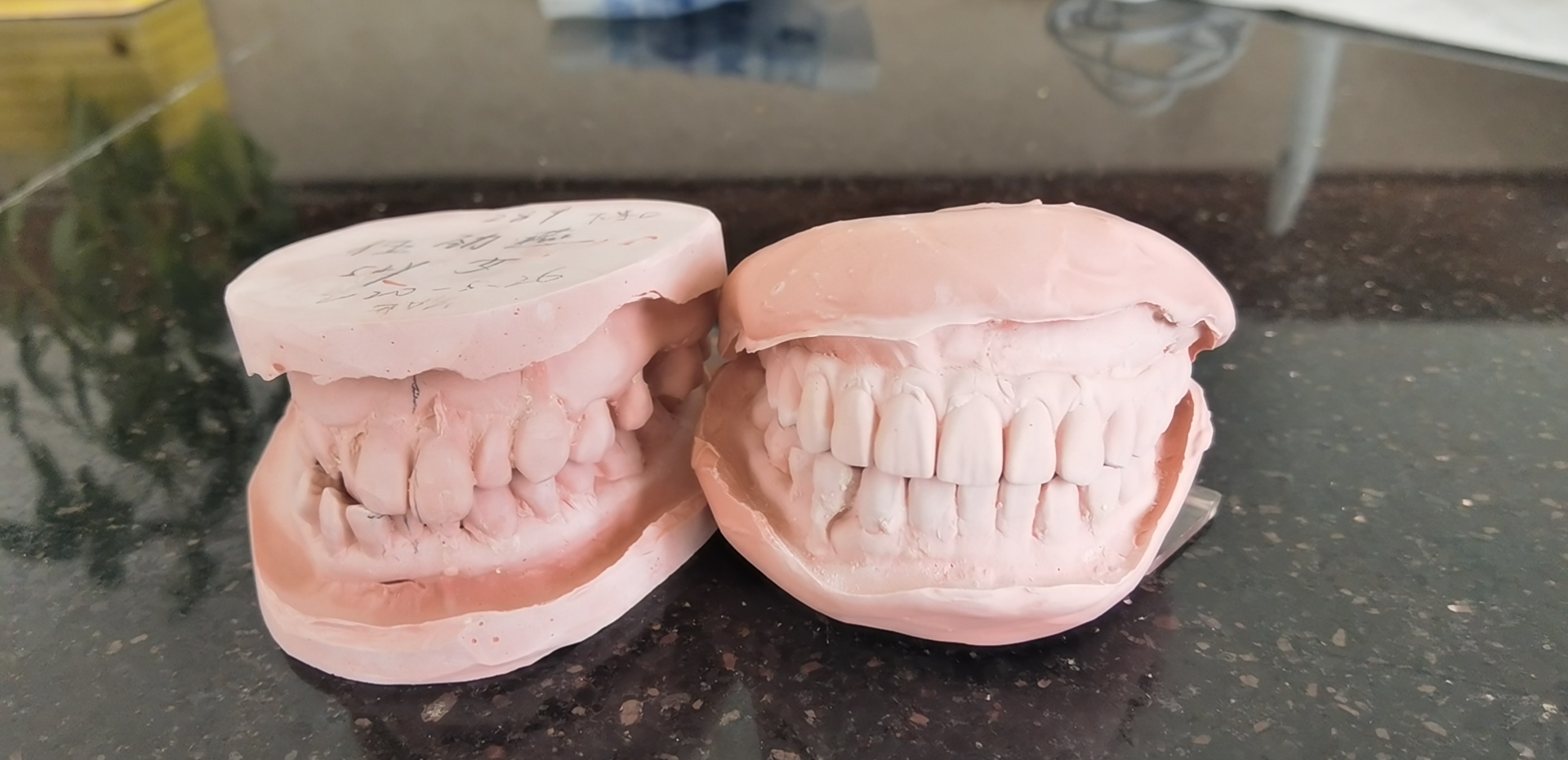 为什么种植一颗牙比一口假牙还贵,假牙成本这么低种牙为啥这么贵