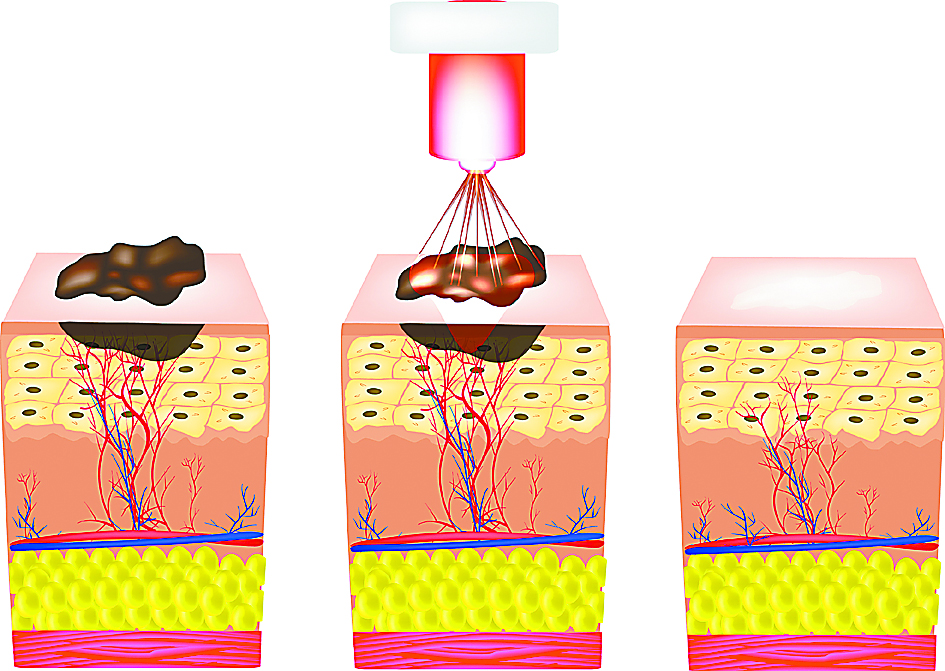 脸上有老年斑痣雀斑怎么办,脸上雀斑老年斑怎么去除
