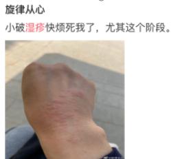 又痒又痛的红色疹子,又长湿疹又长荨麻疹怎么办