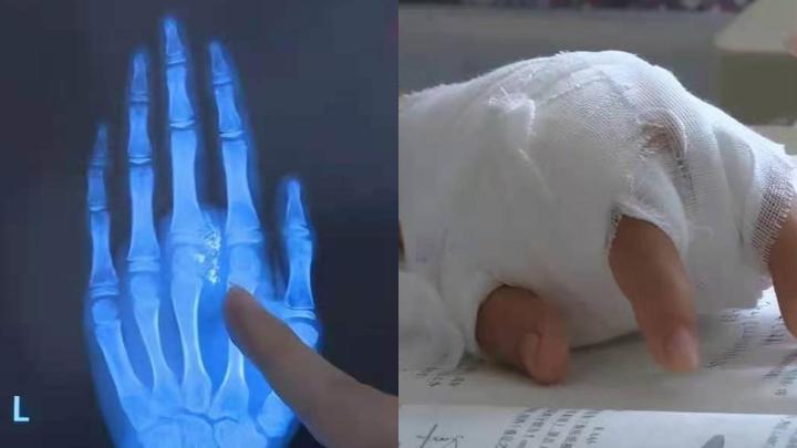 水银温度计断了对身体有什么危害,小孩弄断了水银温度计