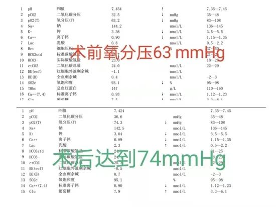肺动静脉畸形介入手术成功率,肺动静脉畸形介入手术全过程