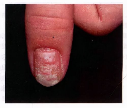 脚指甲盖发黄变厚有竖纹怎么回事,涨知识现象