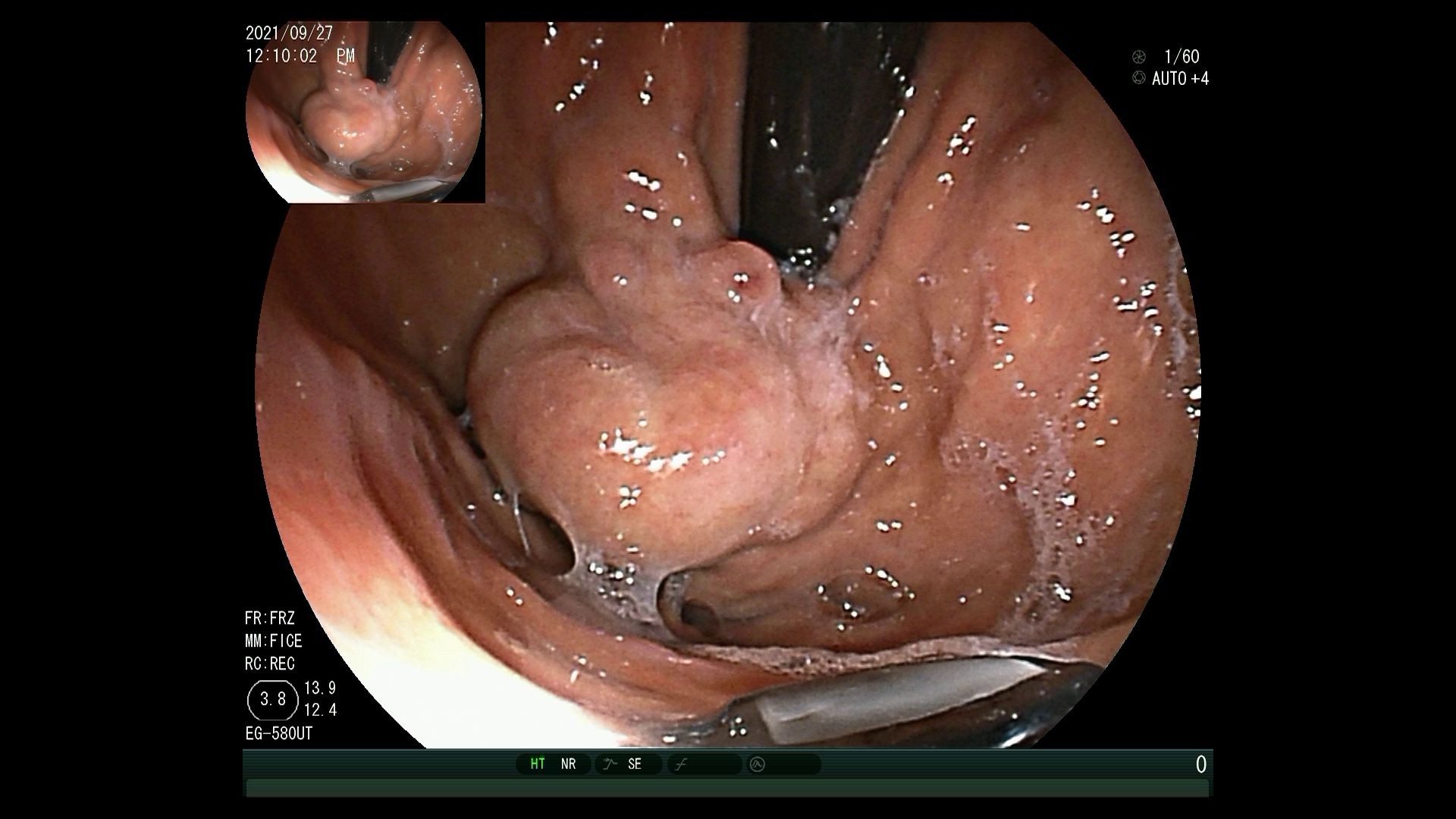 毓璜顶医院国内领先开展超声内镜引导下弹簧圈置入联合组织胶栓塞术治疗伴自发分流的巨大胃底静脉曲张