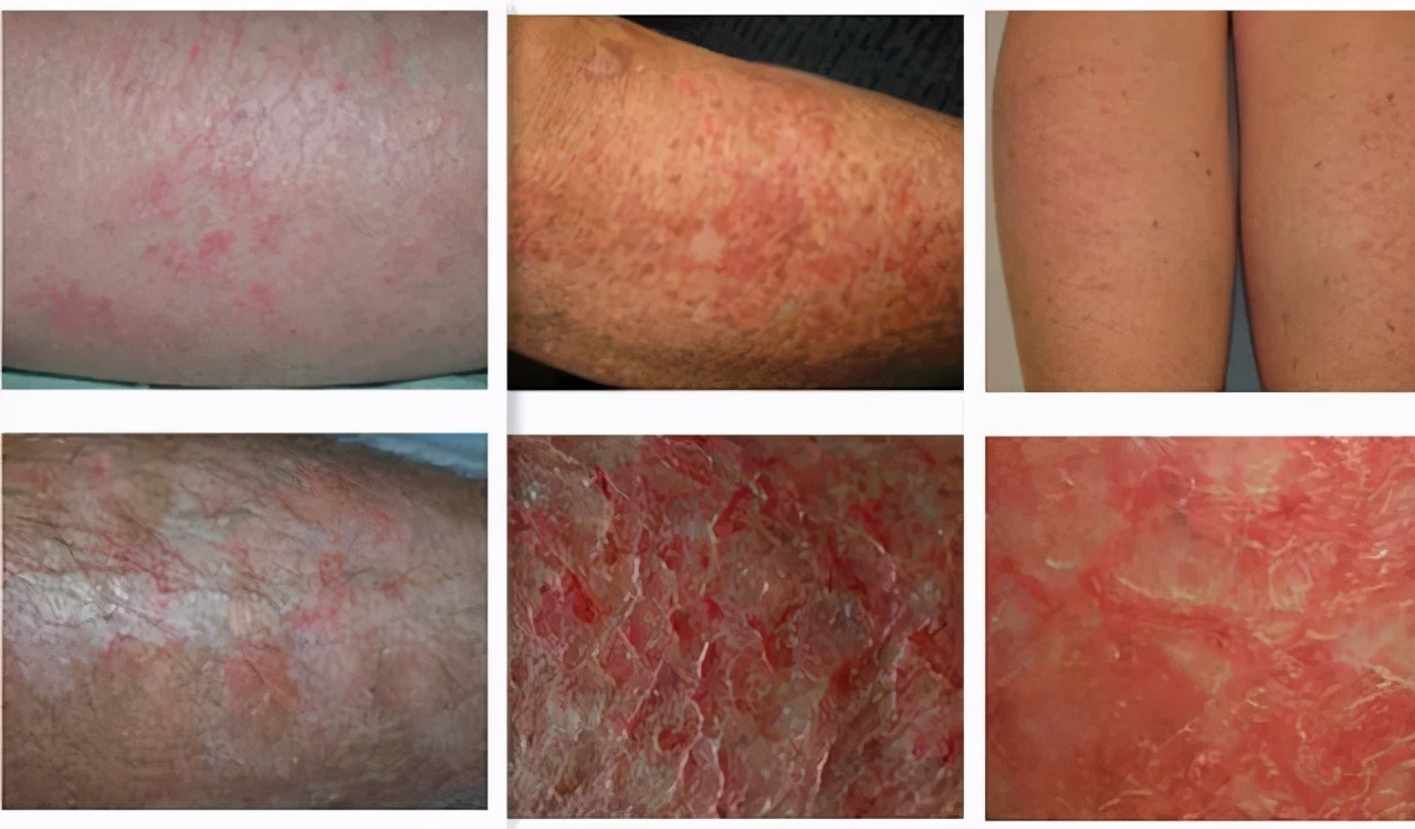 冬天烤火起了好多红疹怎么办,烤火皮肤受到感染症状